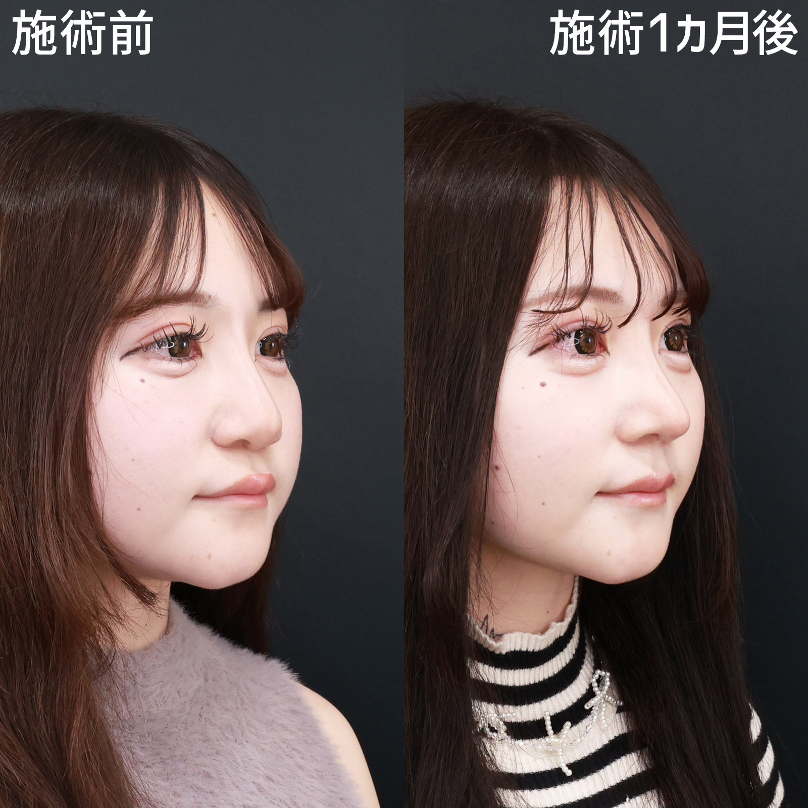 鼻中隔延長術/鼻尖形成・鼻尖縮小/鼻先軟骨移植の症例写真 施術前後 