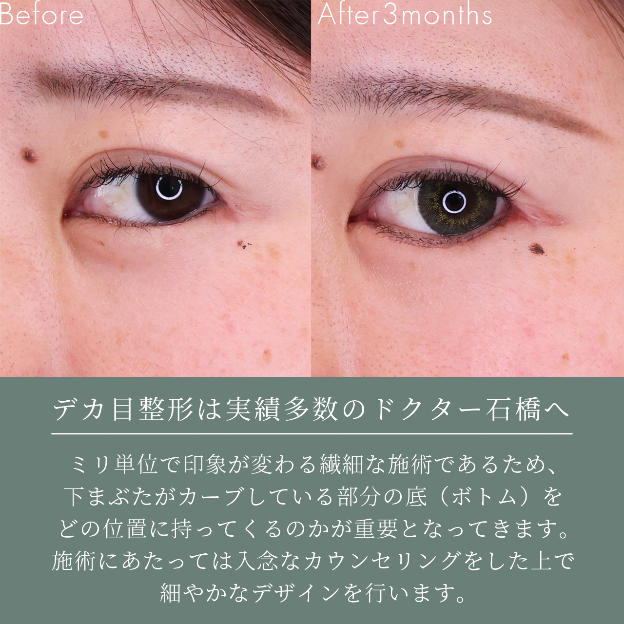 グラマラスライン（タレ目形成）の症例写真 施術前後 