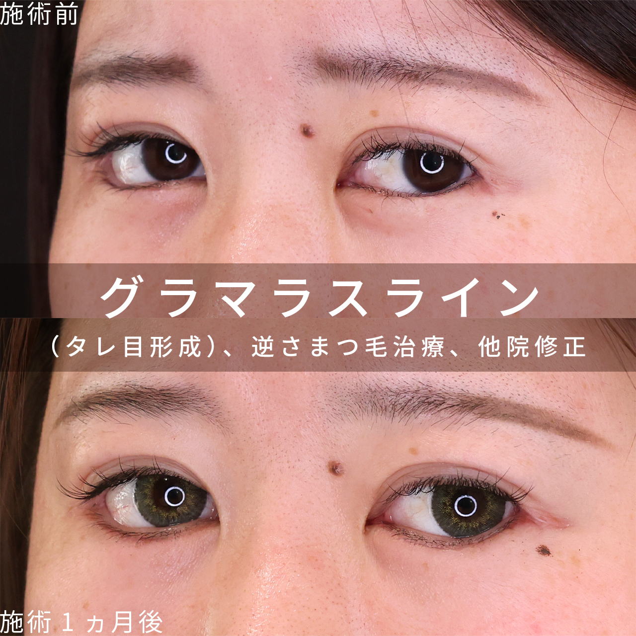 グラマラスライン（タレ目形成）の症例写真 施術前後 