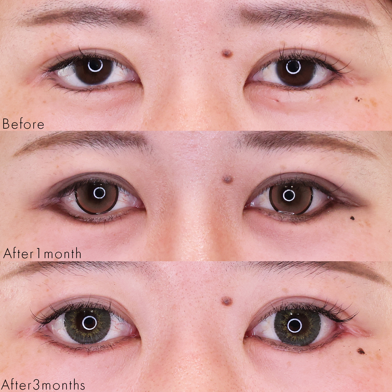 グラマラスライン（タレ目形成）の症例写真 施術前後 