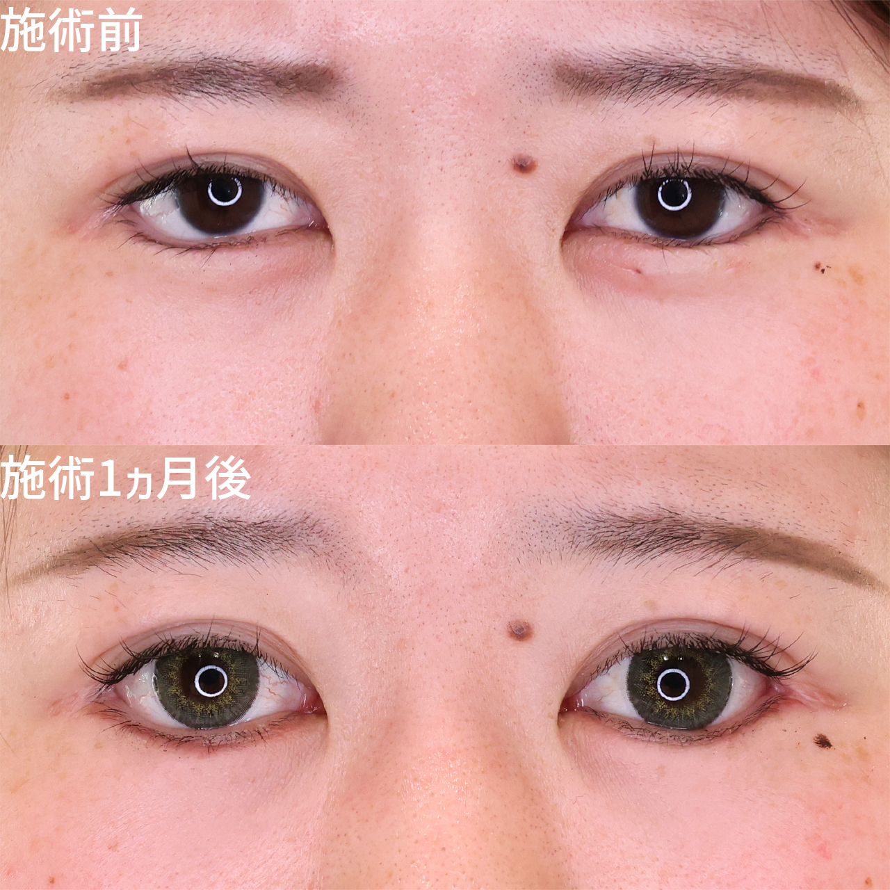 タレ目形成+逆さまつ毛改善 グラマラスなお目元で印象◎