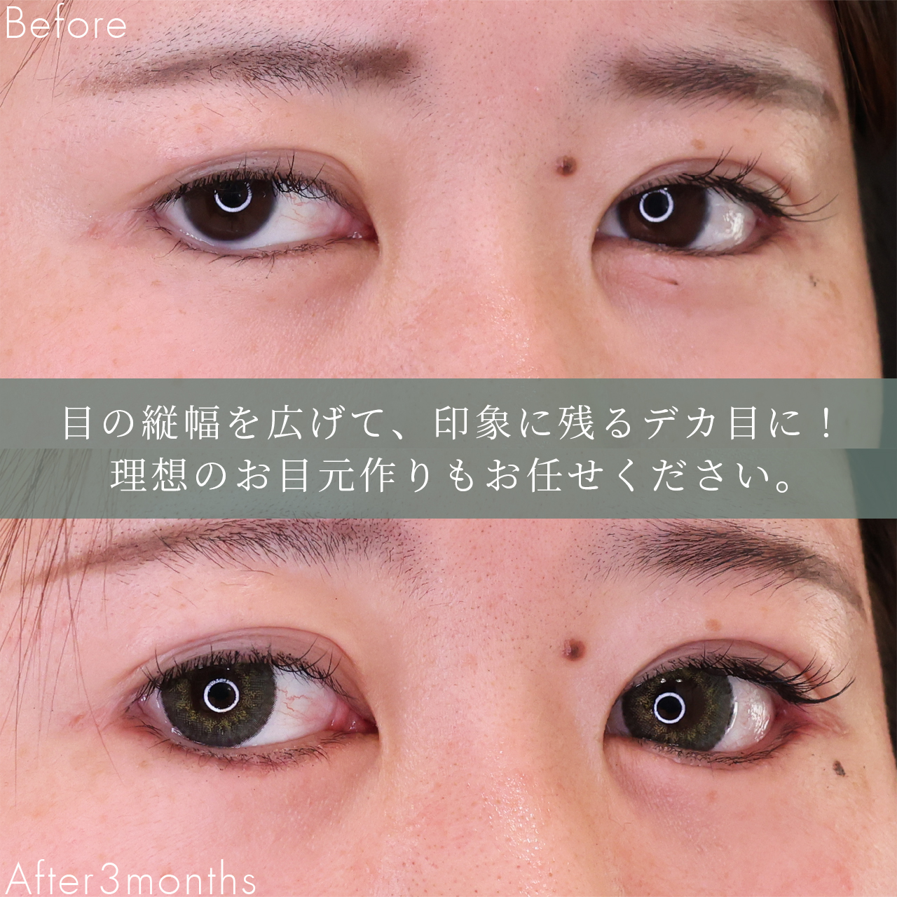 グラマラスライン（タレ目形成）の症例写真 施術前後 