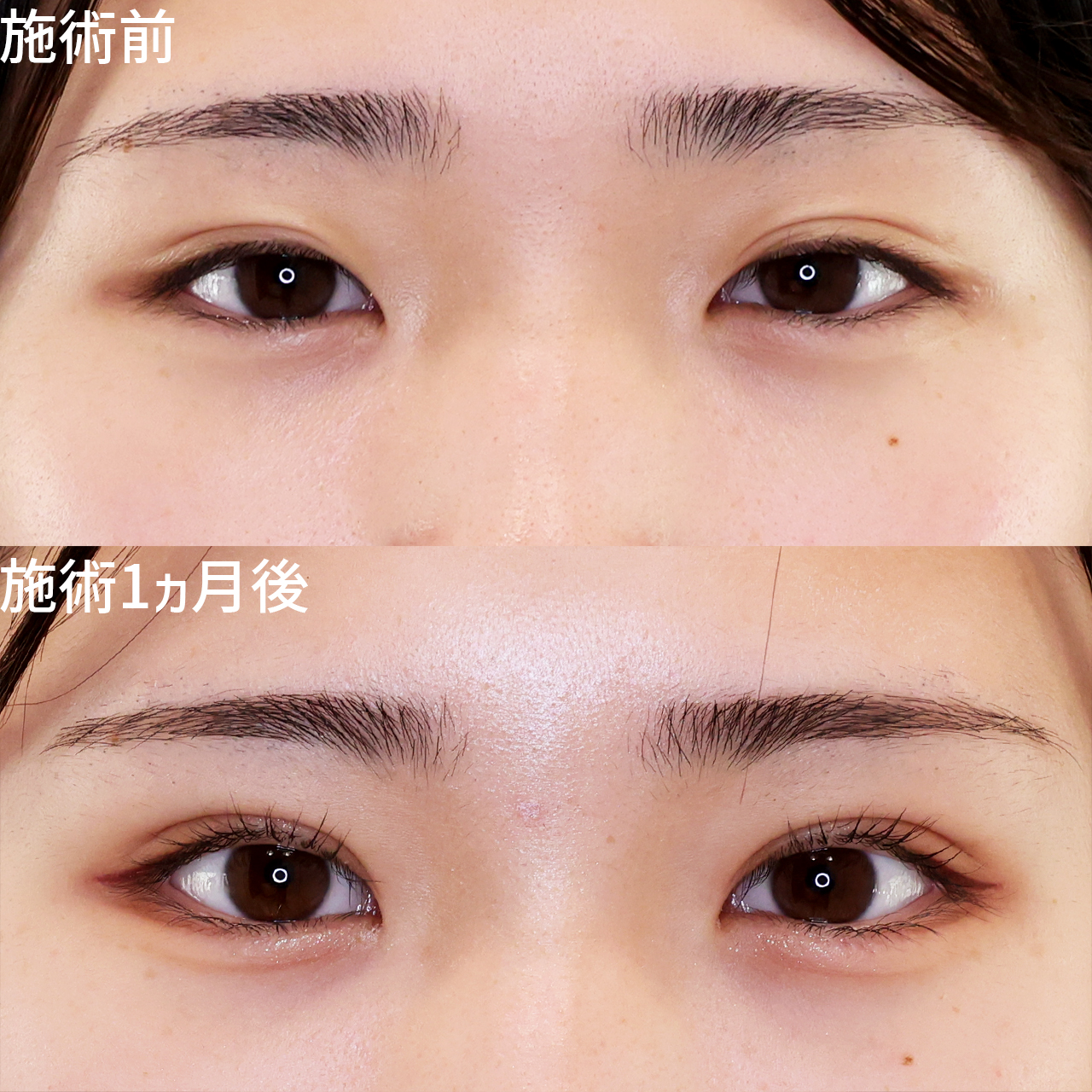 毎日のメイク時短に パッチリ二重ラインを作るならTAクリニック！