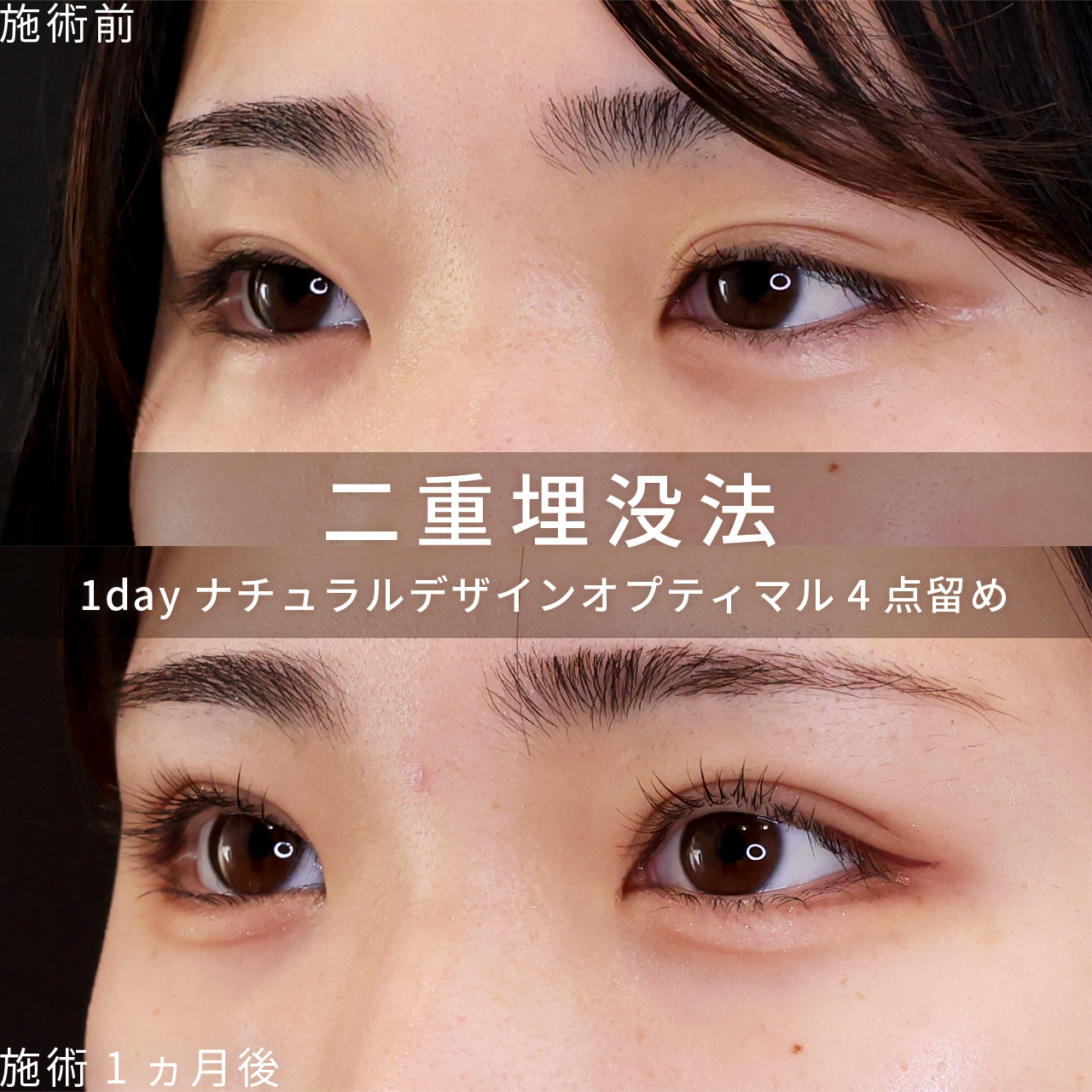 二重埋没法の症例写真 施術前後