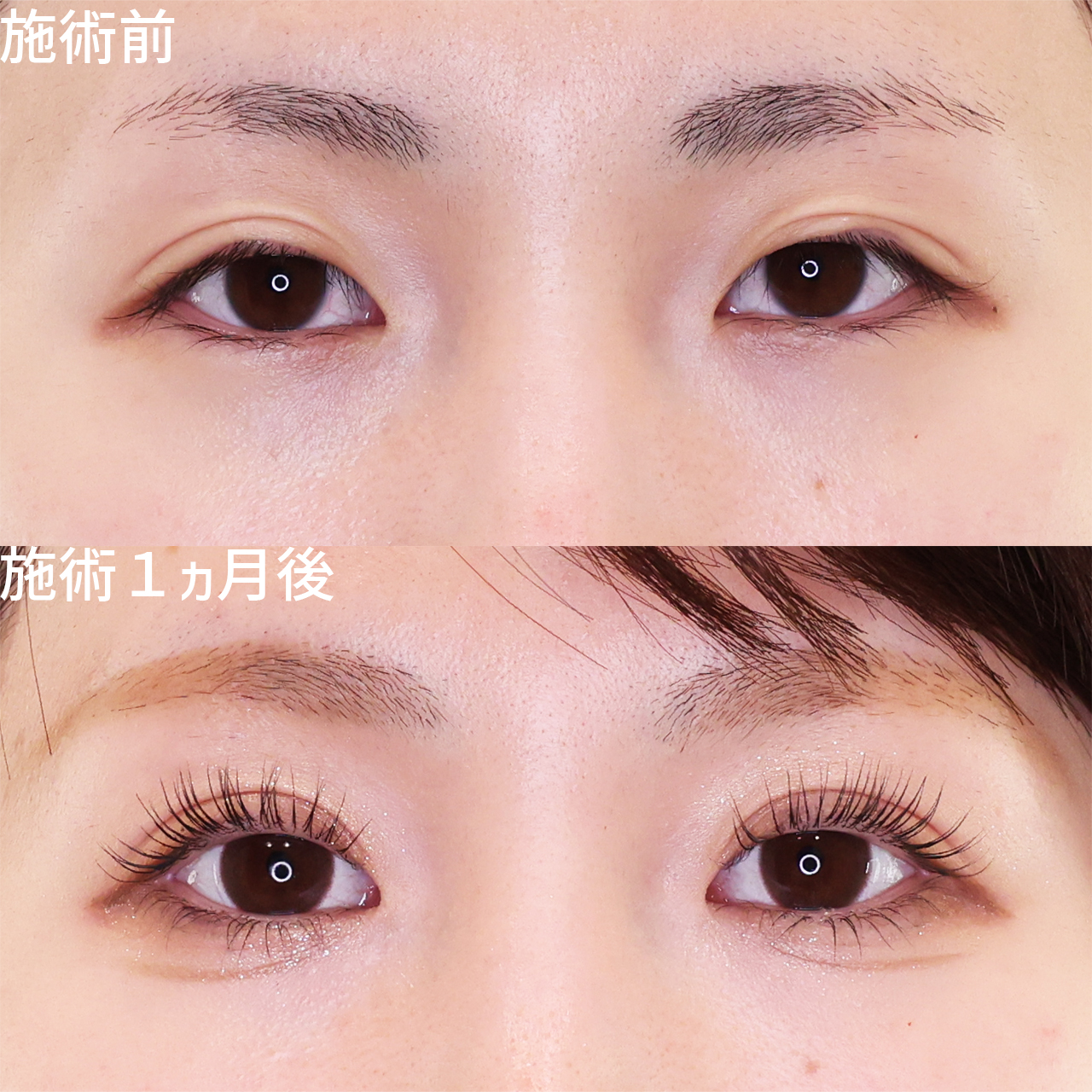 華やかパッチリ二重！たるみまぶたを改善して垢抜け目元に