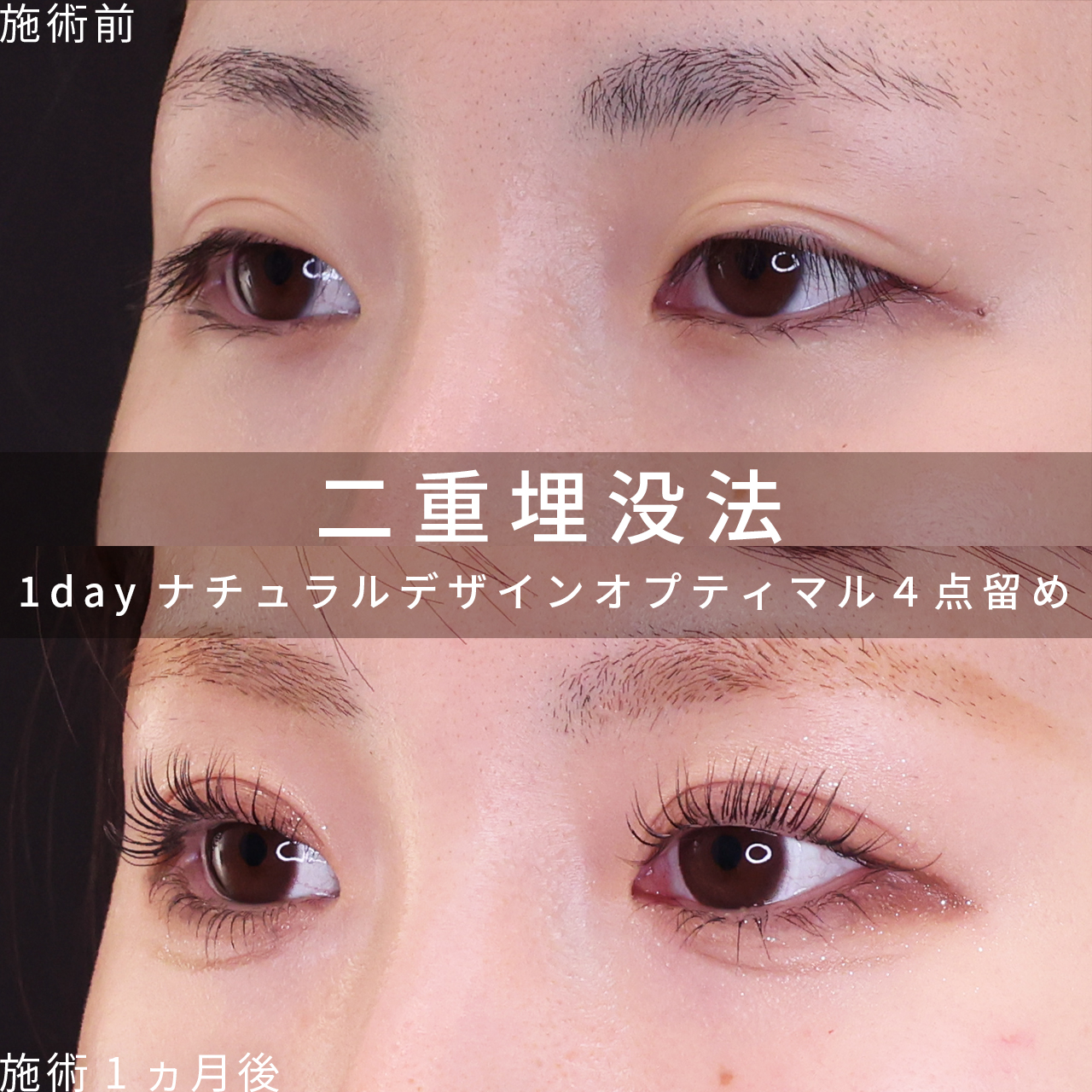 二重埋没法の症例写真 施術前後 