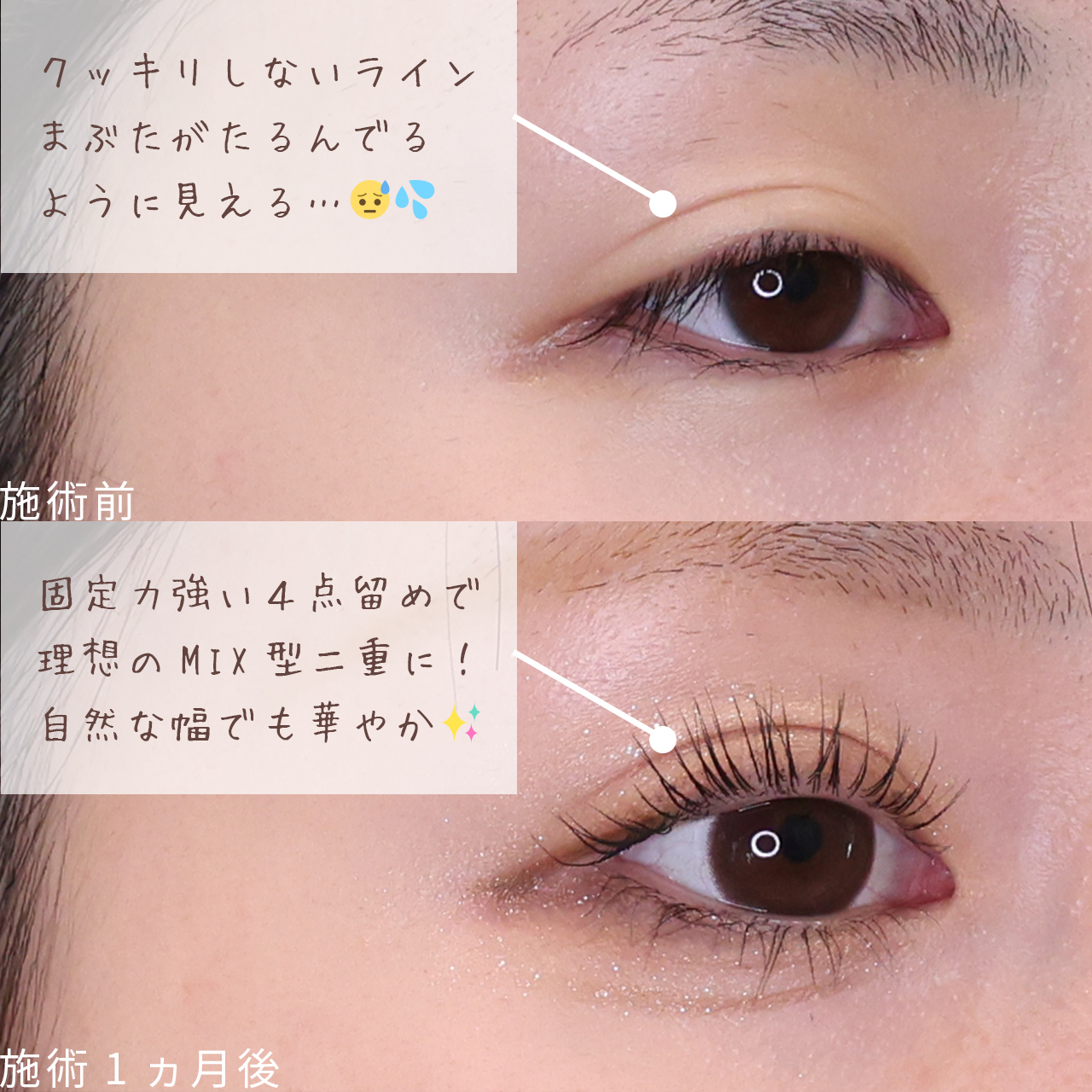 二重埋没法の症例写真 施術前後 