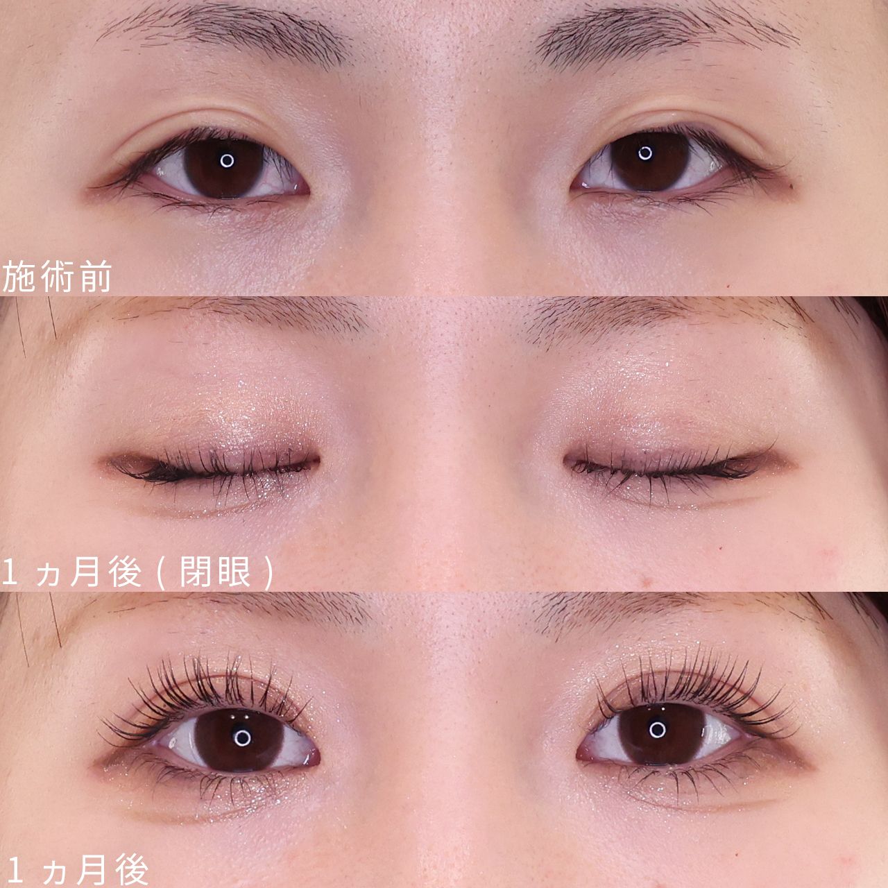 二重埋没法の症例写真 施術前後 