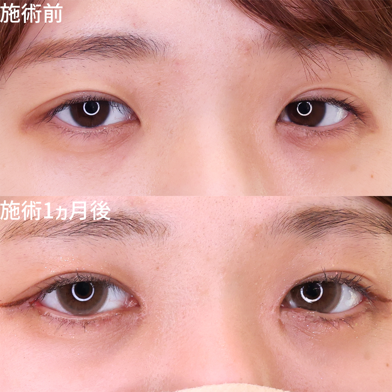 グラマラスライン（タレ目形成）/目頭切開術/目尻切開術の症例写真 施術前後 