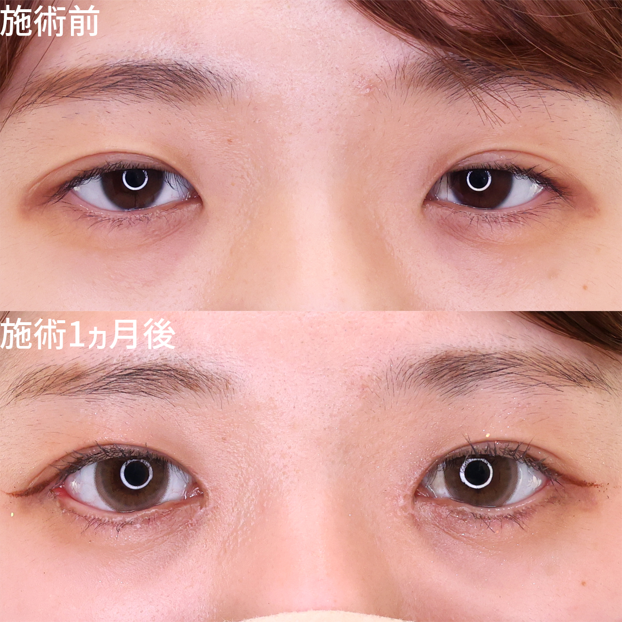 【タレ目】目の縦幅・横幅を広げて、印象に残りやすい可愛いお目元に【デカ目】