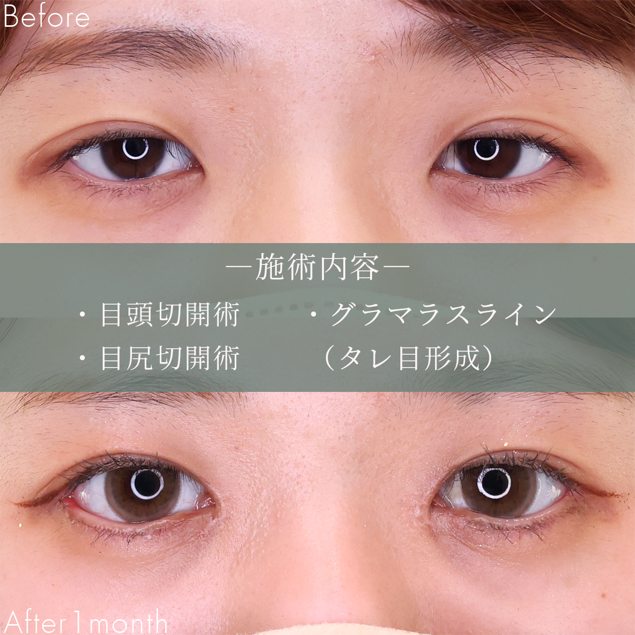 グラマラスライン（タレ目形成）/目頭切開術/目尻切開術の症例写真 施術前後 