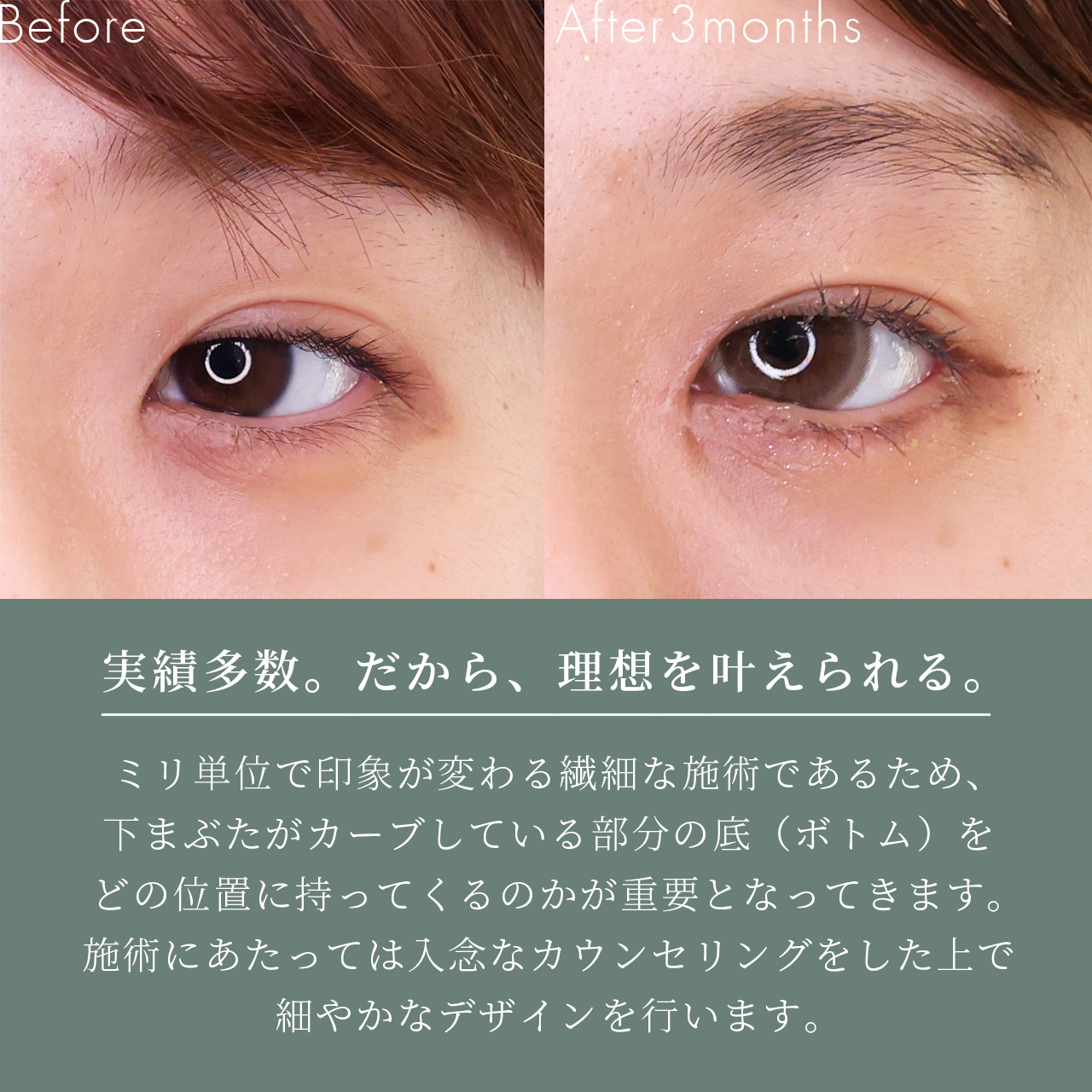 グラマラスライン（タレ目形成）/目頭切開術/目尻切開術の症例写真 施術前後 