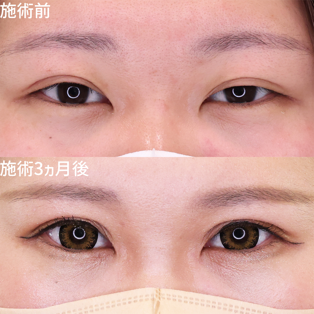 【他院埋没修正】上まぶたのたるみを切除し、半永久的な二重に!【上眼瞼切開術】