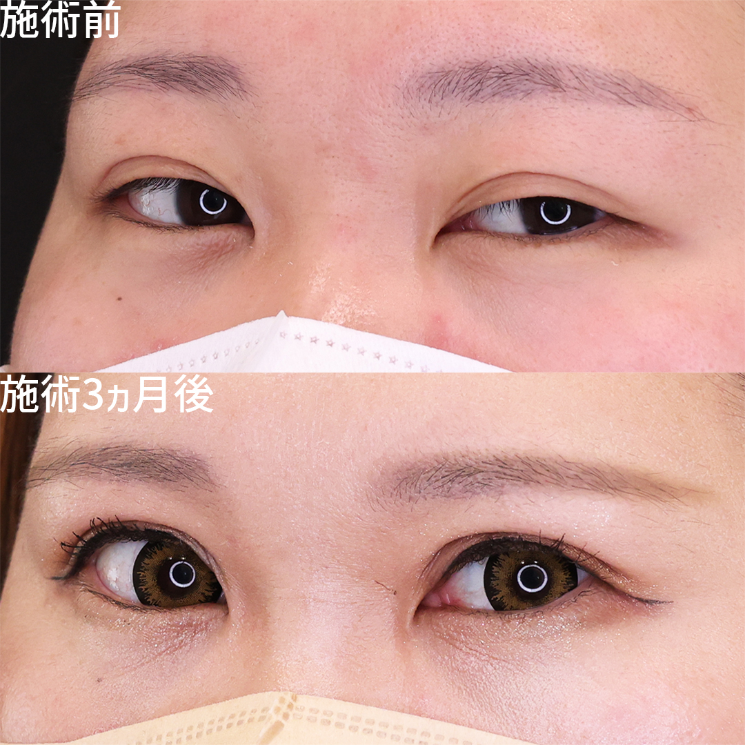 上眼瞼切開術の症例写真 施術前後 