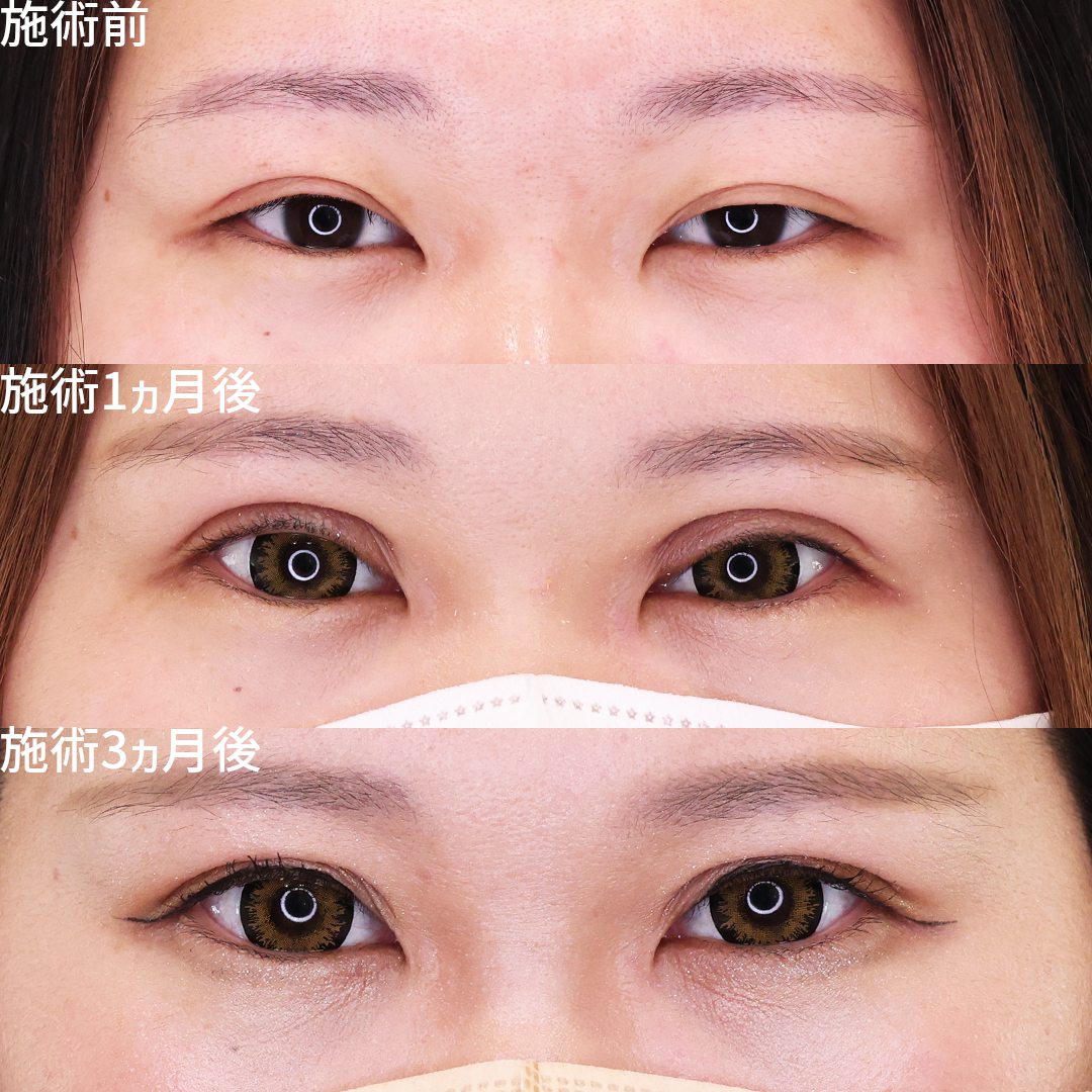 上眼瞼切開術の症例写真 施術前後 