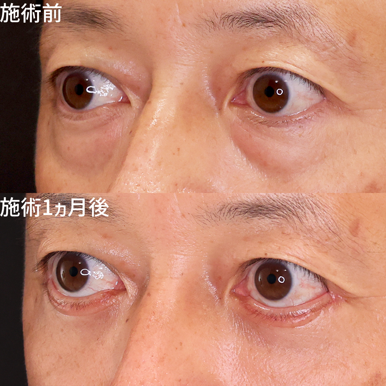 見た目40代→30代に クマ取り整形で若々しさキープ！【メンズ美容】