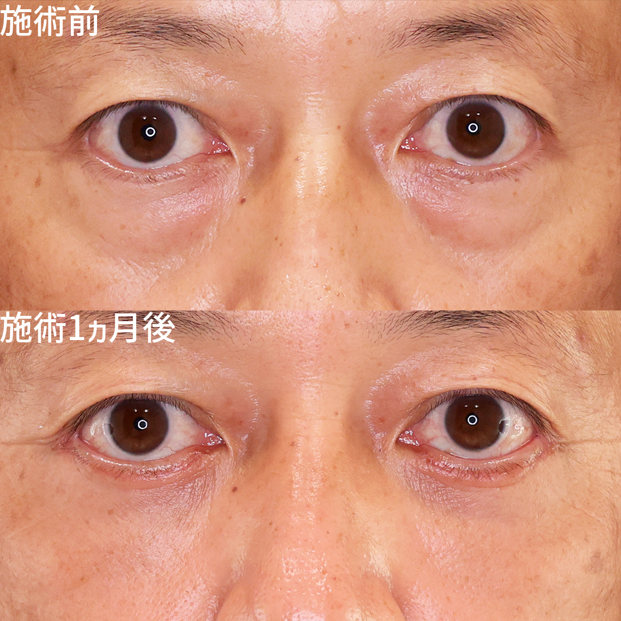 下眼瞼切開術（クマ・たるみとり）/下眼瞼脱脂術（目の下のたるみ取り・目の下の脂肪ふくらみ取り）/顔の脂肪注入(コンデンスリッチフェイス)の症例写真 施術前後 