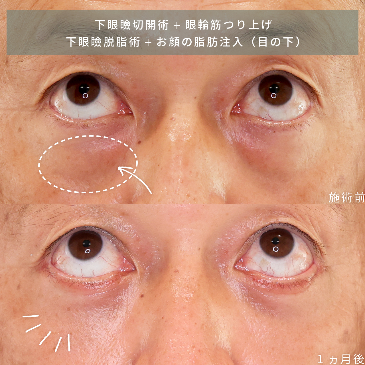 下眼瞼切開術（クマ・たるみとり）/下眼瞼脱脂術（目の下のたるみ取り・目の下の脂肪ふくらみ取り）/顔の脂肪注入(コンデンスリッチフェイス)の症例写真 施術前後 