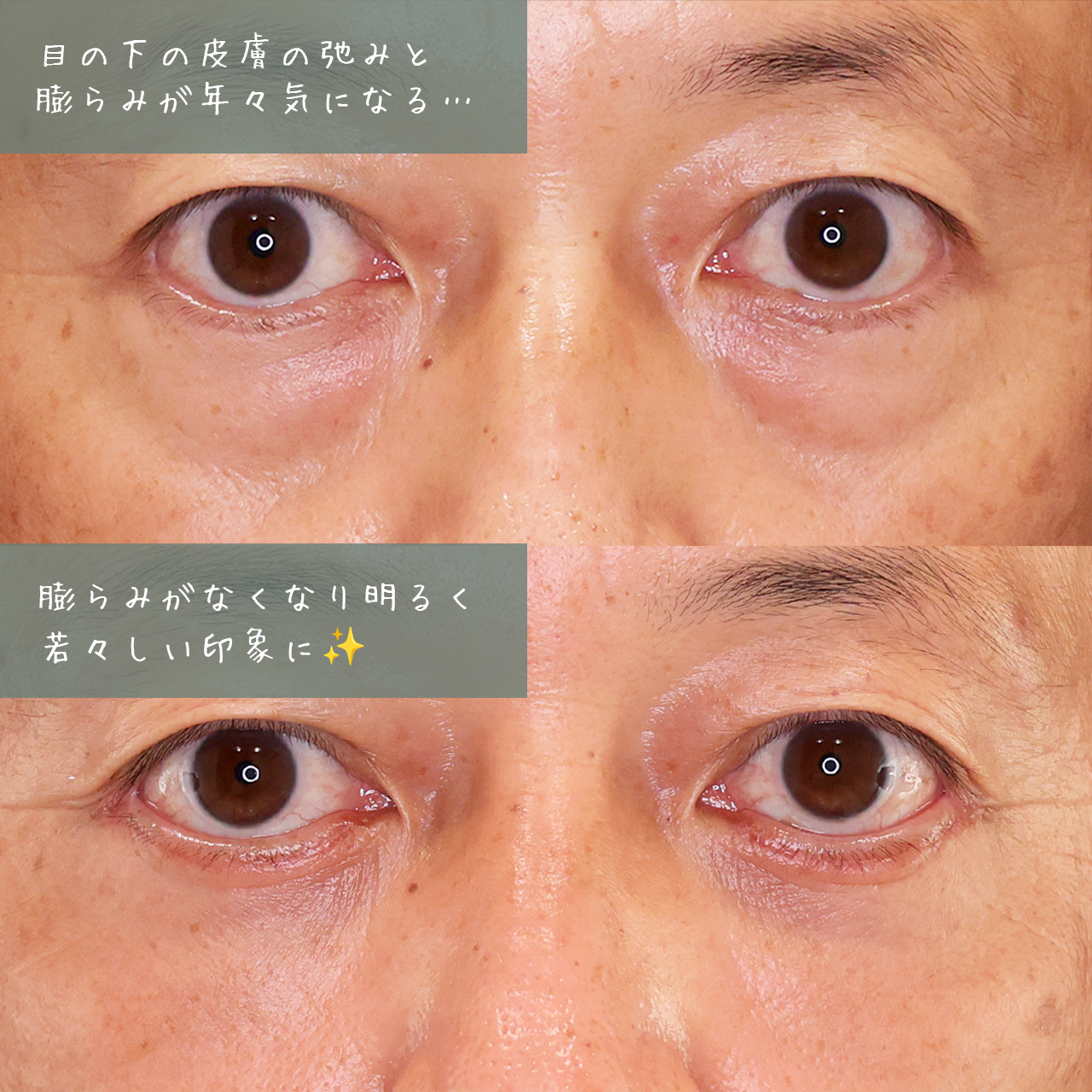 下眼瞼切開術（クマ・たるみとり）/下眼瞼脱脂術（目の下のたるみ取り・目の下の脂肪ふくらみ取り）/顔の脂肪注入(コンデンスリッチフェイス)の症例写真 施術前後 