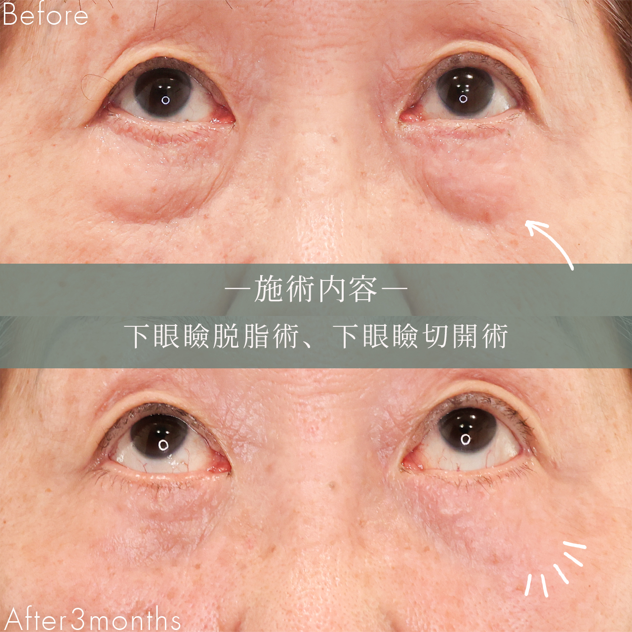 下眼瞼切開術(クマ・たるみとり)/下眼瞼脱脂術(目の下のたるみ取り・目の下の脂肪ふくらみ取り)の症例写真 施術前後