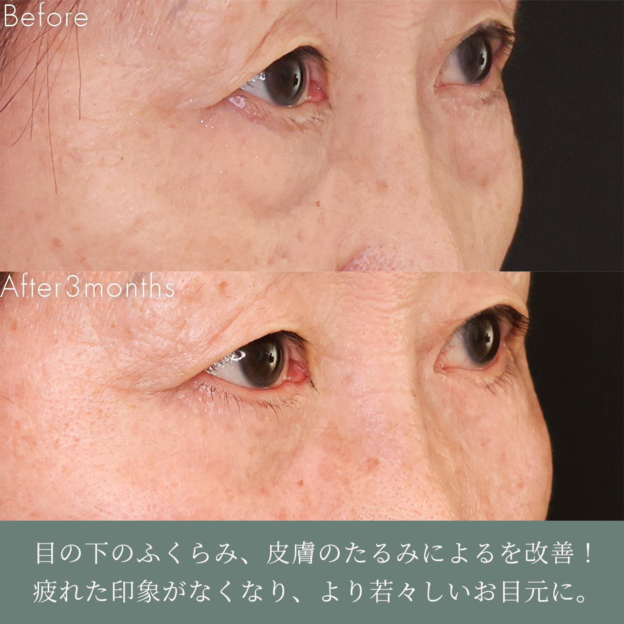 下眼瞼切開術(クマ・たるみとり)/下眼瞼脱脂術(目の下のたるみ取り・目の下の脂肪ふくらみ取り)の症例写真 施術前後