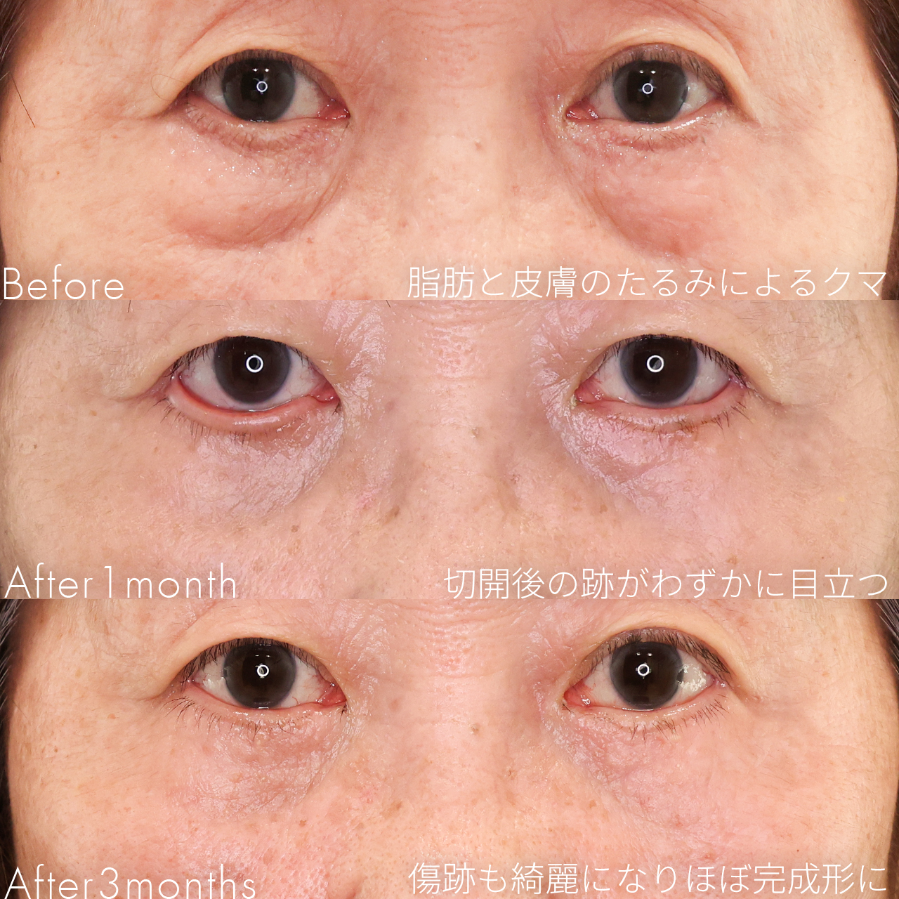 下眼瞼切開術(クマ・たるみとり)/下眼瞼脱脂術(目の下のたるみ取り・目の下の脂肪ふくらみ取り)の症例写真 施術前後