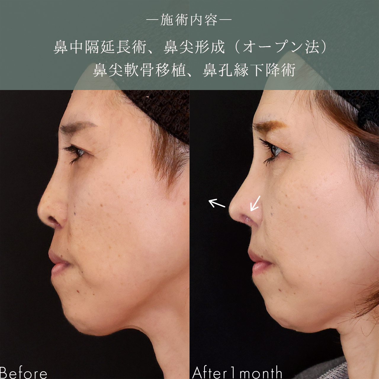 鼻中隔延長術/鼻尖形成・鼻尖縮小/鼻先軟骨移植の症例写真 施術前後 
