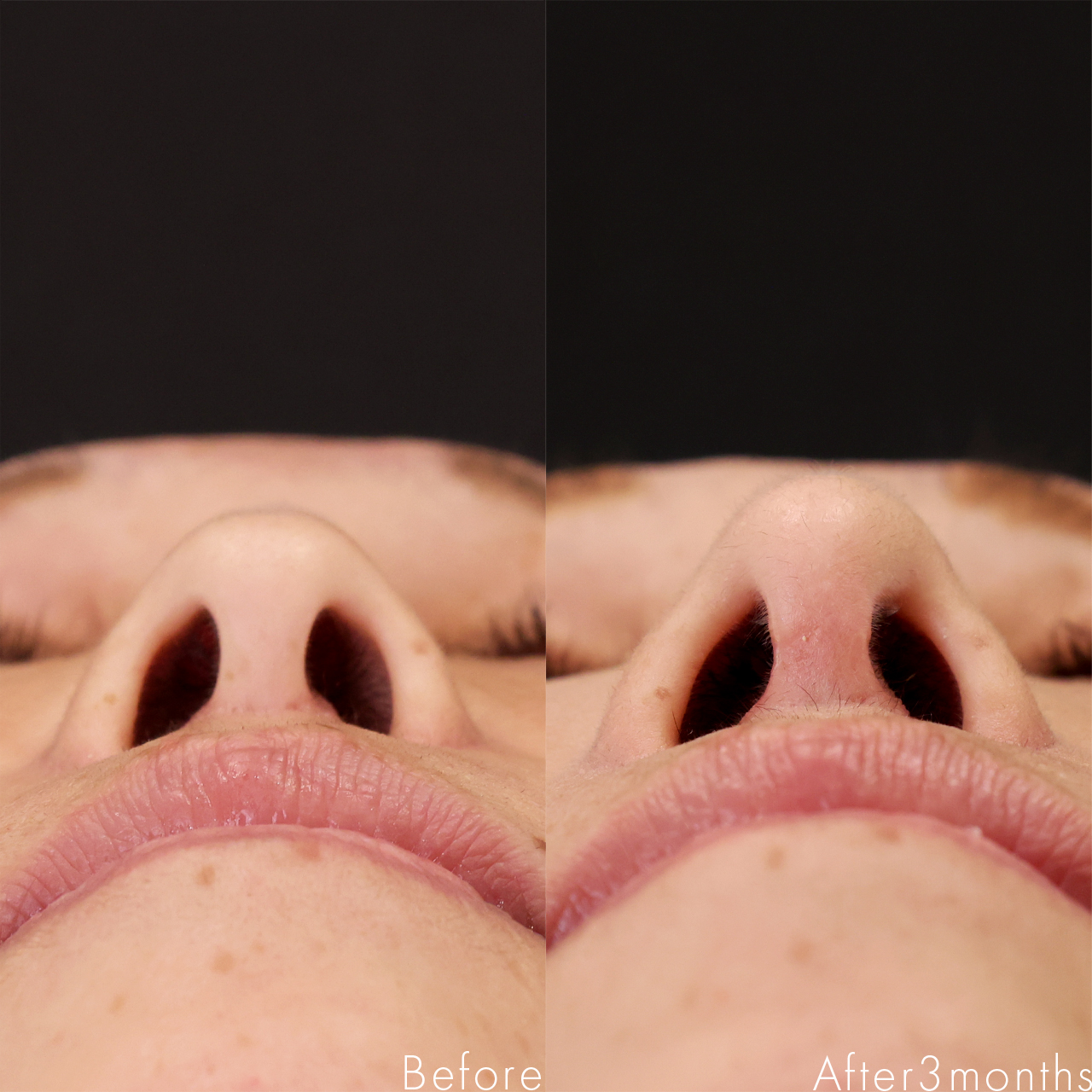 鼻中隔延長術/鼻尖形成・鼻尖縮小/鼻先軟骨移植の症例写真 施術前後 