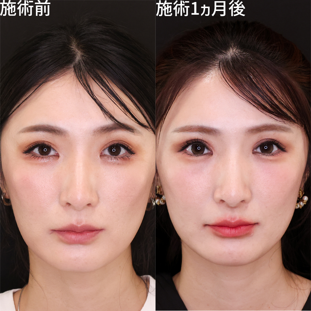 眼瞼下垂 20代の症例写真・画像・ビフォーアフター｜美容整形