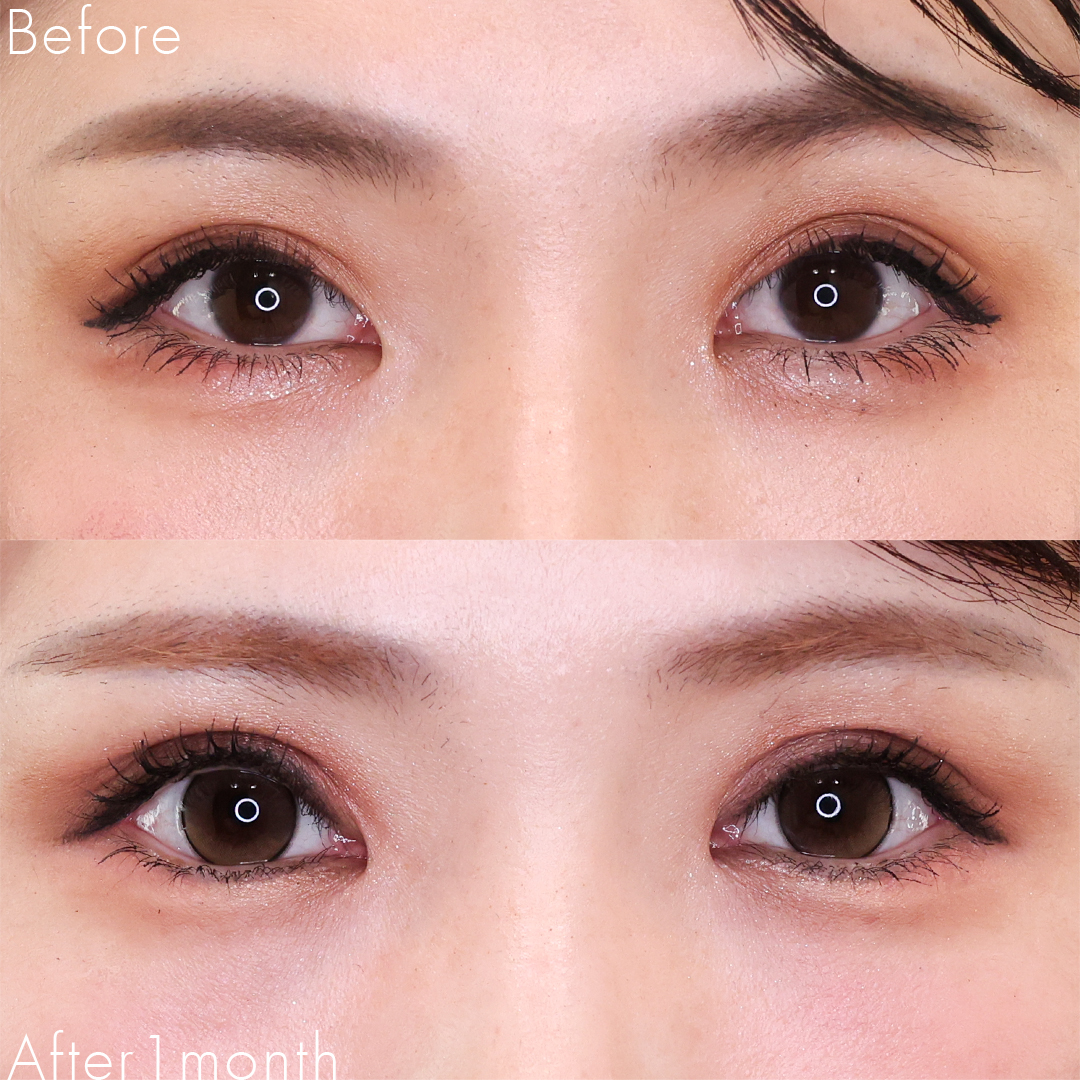 眼瞼下垂（目つき矯正）/上眼瞼切開術/グラマラスライン（タレ目形成）の症例写真 施術前後 
