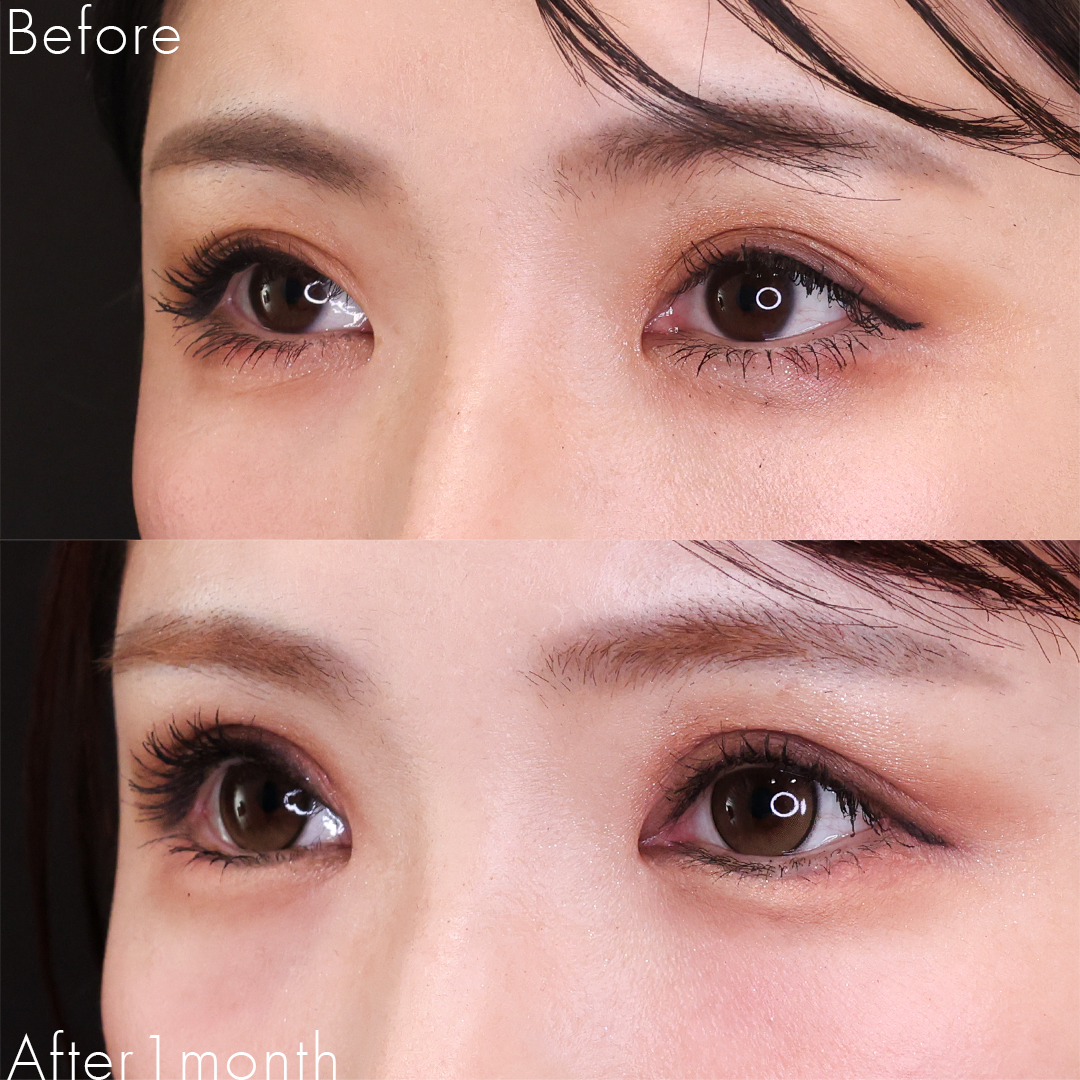 眼瞼下垂（目つき矯正）/上眼瞼切開術/グラマラスライン（タレ目形成）の症例写真 施術前後 