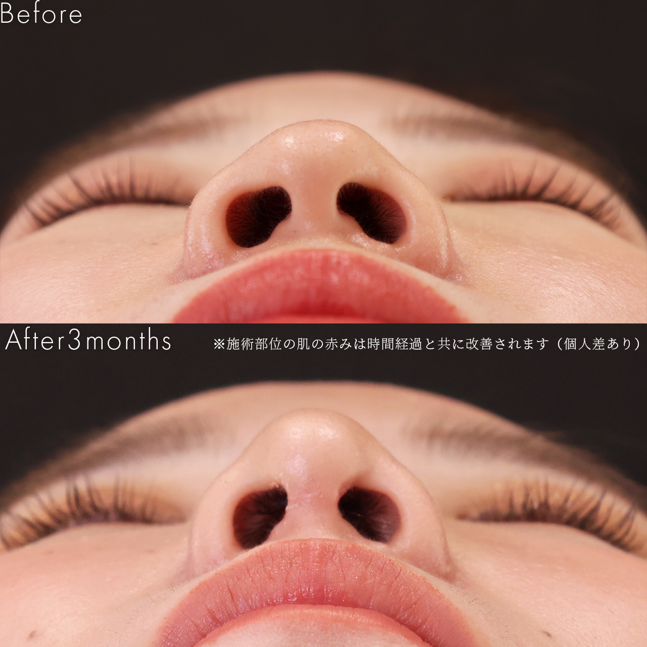 TAC式 ツヤ肌コラーゲンリフト®/エラボトックス注射/顔の脂肪注入(コンデンスリッチフェイス)の症例写真 施術前後 