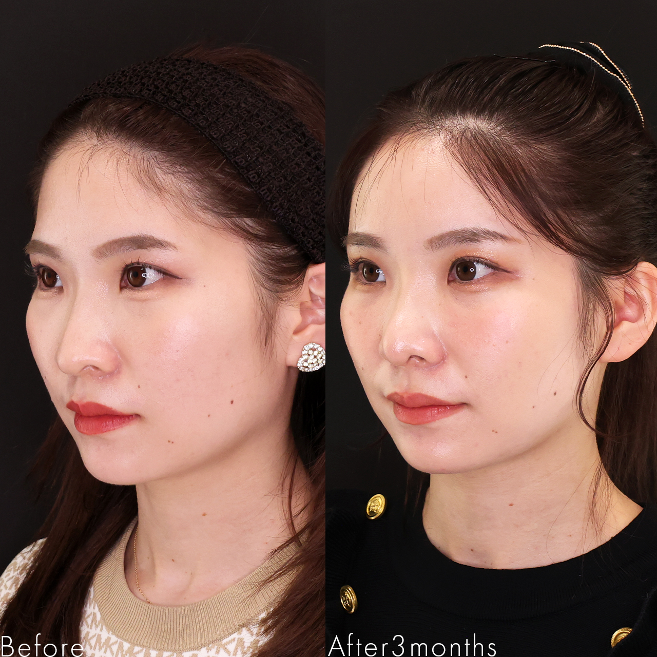 TAC式 ツヤ肌コラーゲンリフト®/エラボトックス注射/顔の脂肪注入(コンデンスリッチフェイス)の症例写真 施術前後 