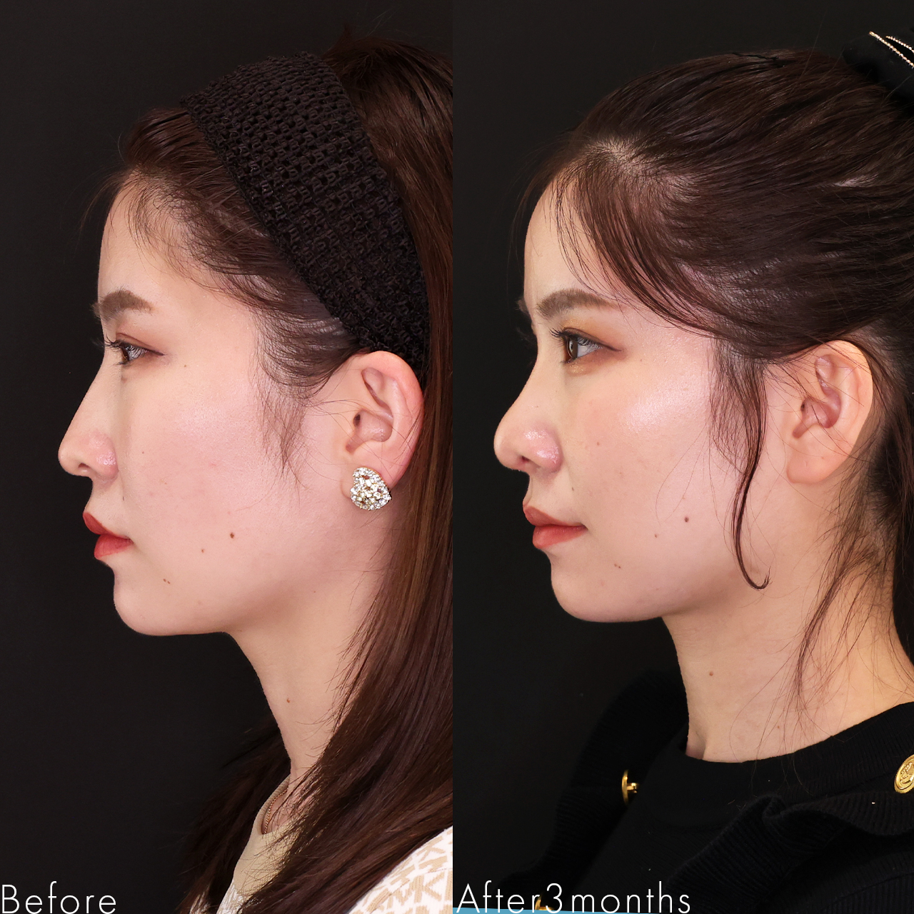 TAC式 ツヤ肌コラーゲンリフト®/エラボトックス注射/顔の脂肪注入(コンデンスリッチフェイス)の症例写真 施術前後 