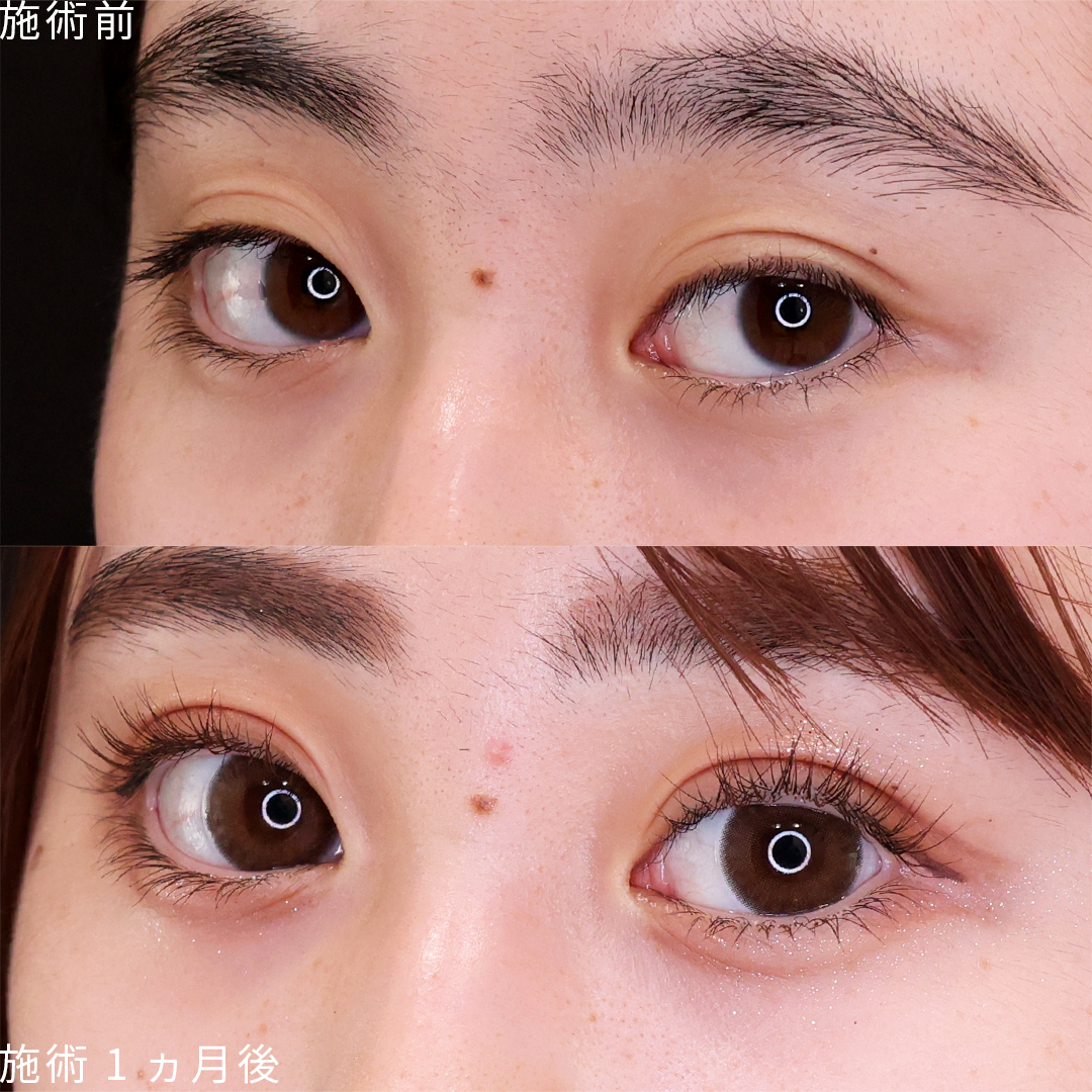 二重埋没法の症例写真 施術前後 