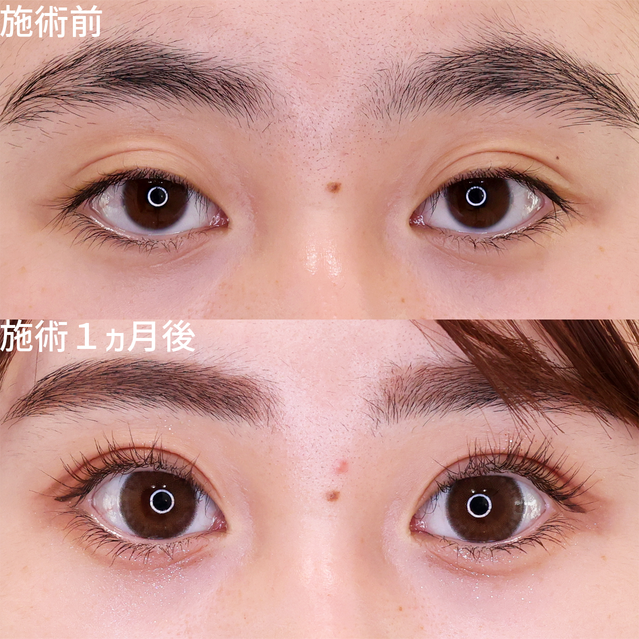 左右差を整え、目力と可愛らしさをアップ！グッと垢抜ける二重整形