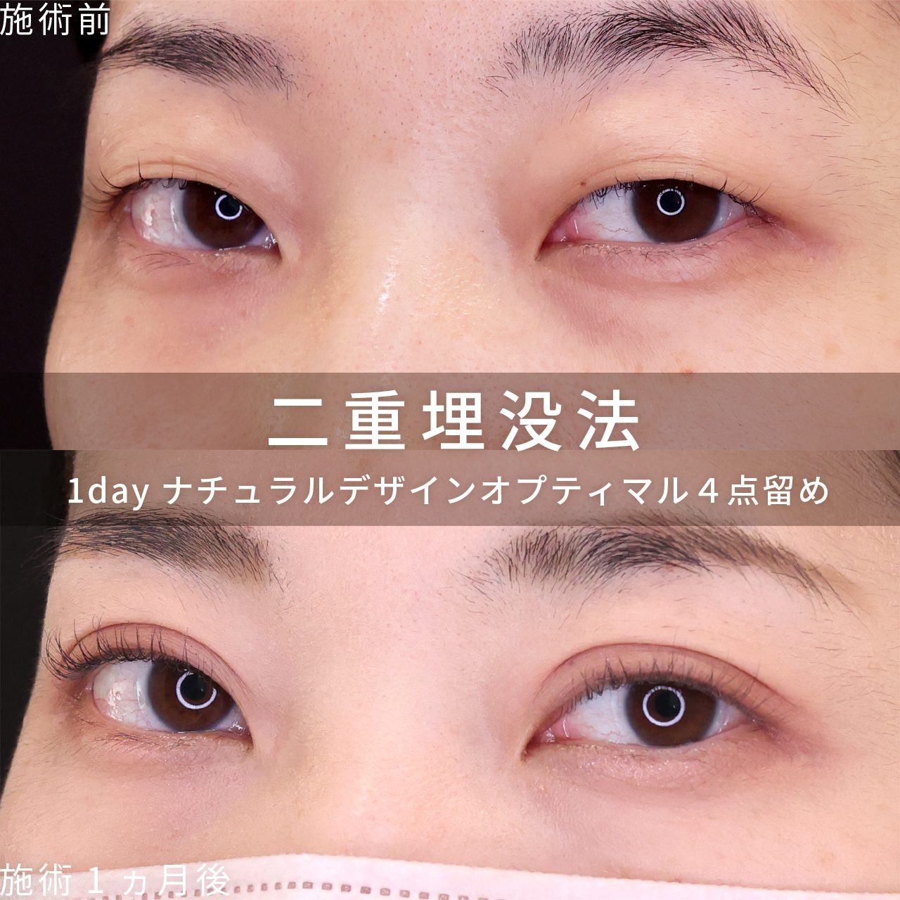 二重埋没法の症例写真 施術前後