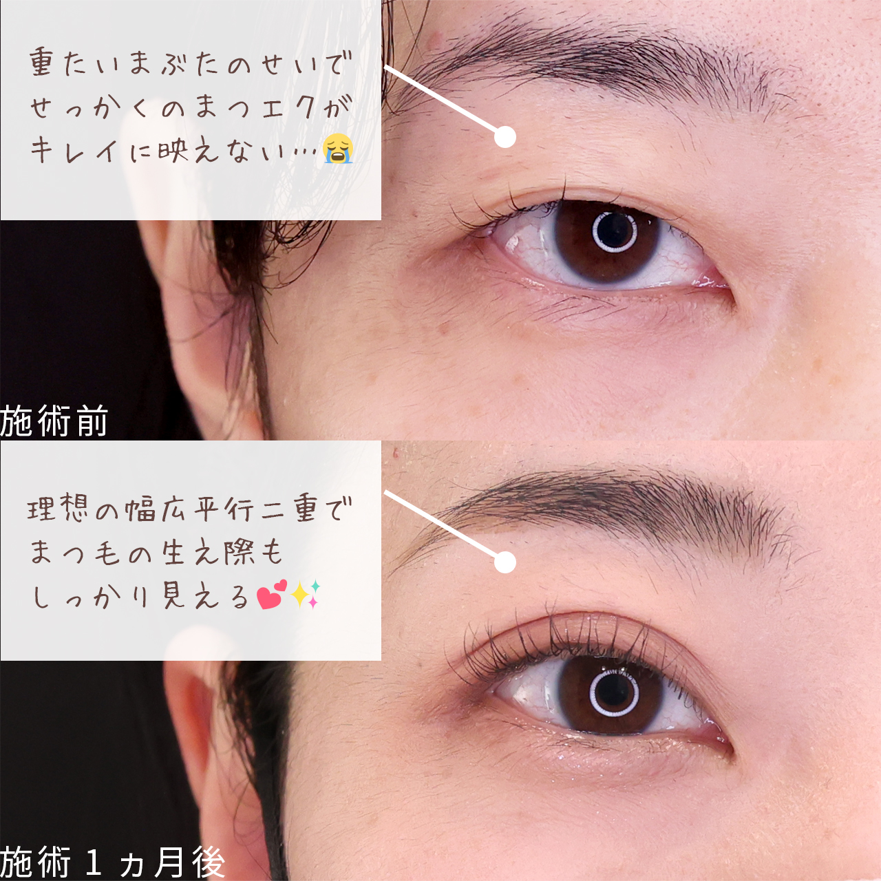 二重埋没法の症例写真 施術前後