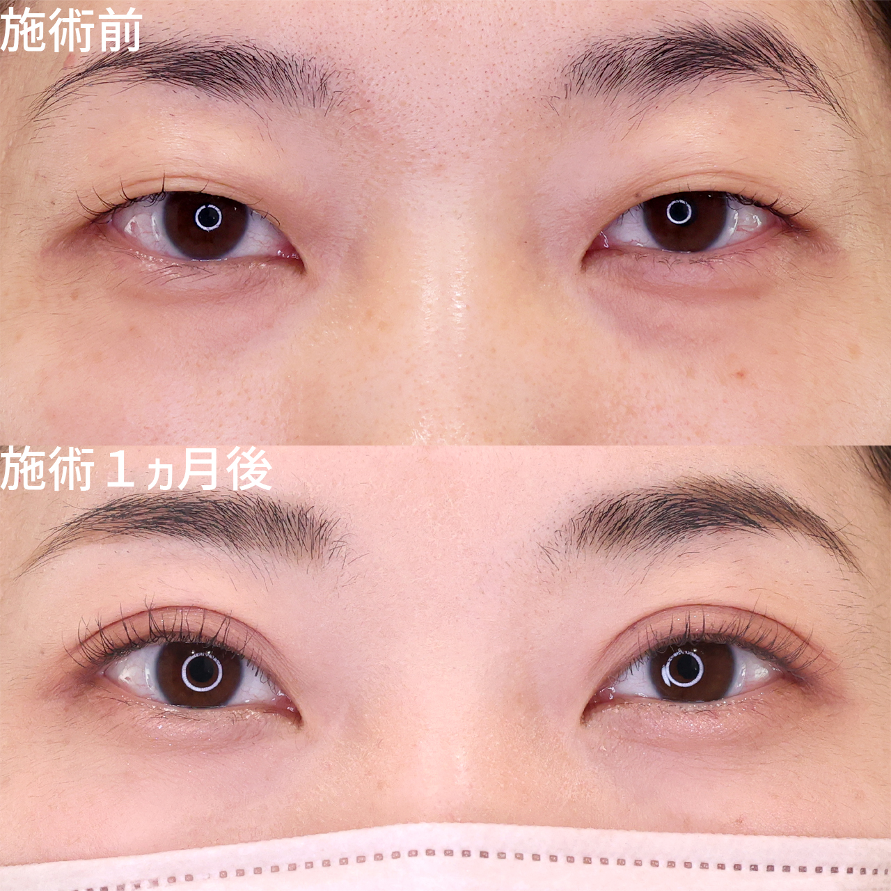 「新しい自分になる」重ため一重から自然な垢抜け二重に【二重まぶた埋没法】