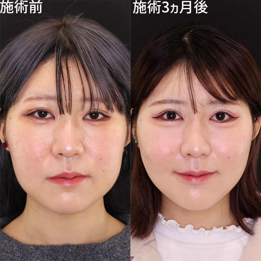 【目元整形×小顔整形】自信を持てる新しい自分に【トータルビューティー】