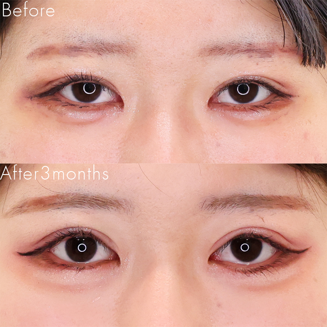 上眼瞼切開術/眼瞼下垂（目つき矯正）/グラマラスライン（タレ目形成）の症例写真 施術前後 