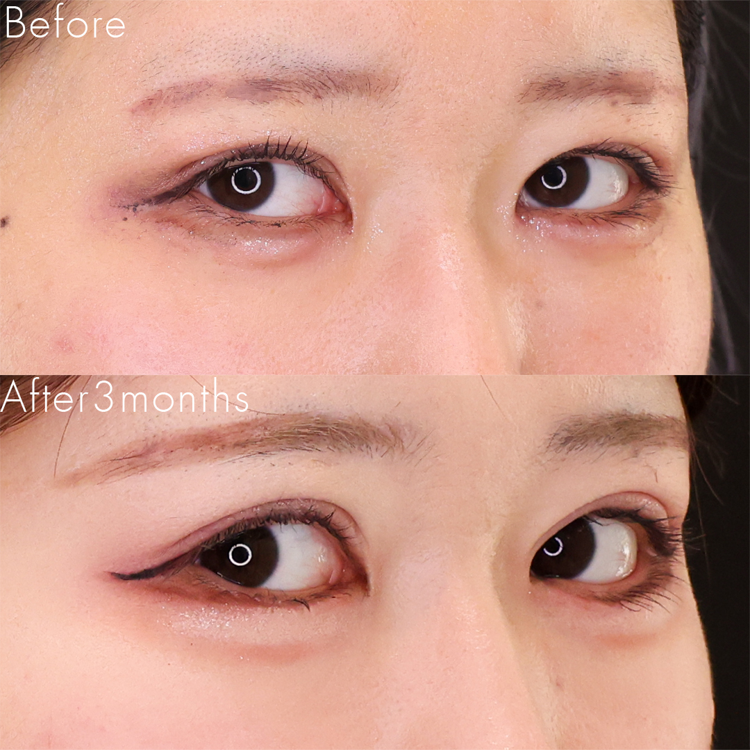 上眼瞼切開術/眼瞼下垂（目つき矯正）/グラマラスライン（タレ目形成）の症例写真 施術前後 