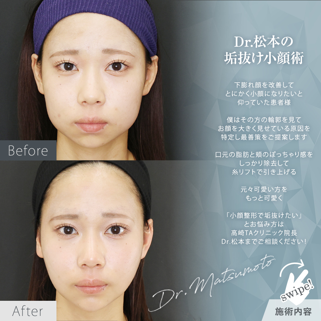 TAC式 ツヤ肌コラーゲンリフト®/顎のヒアルロン酸注射/ジョールファット除去の症例写真 施術前後 
