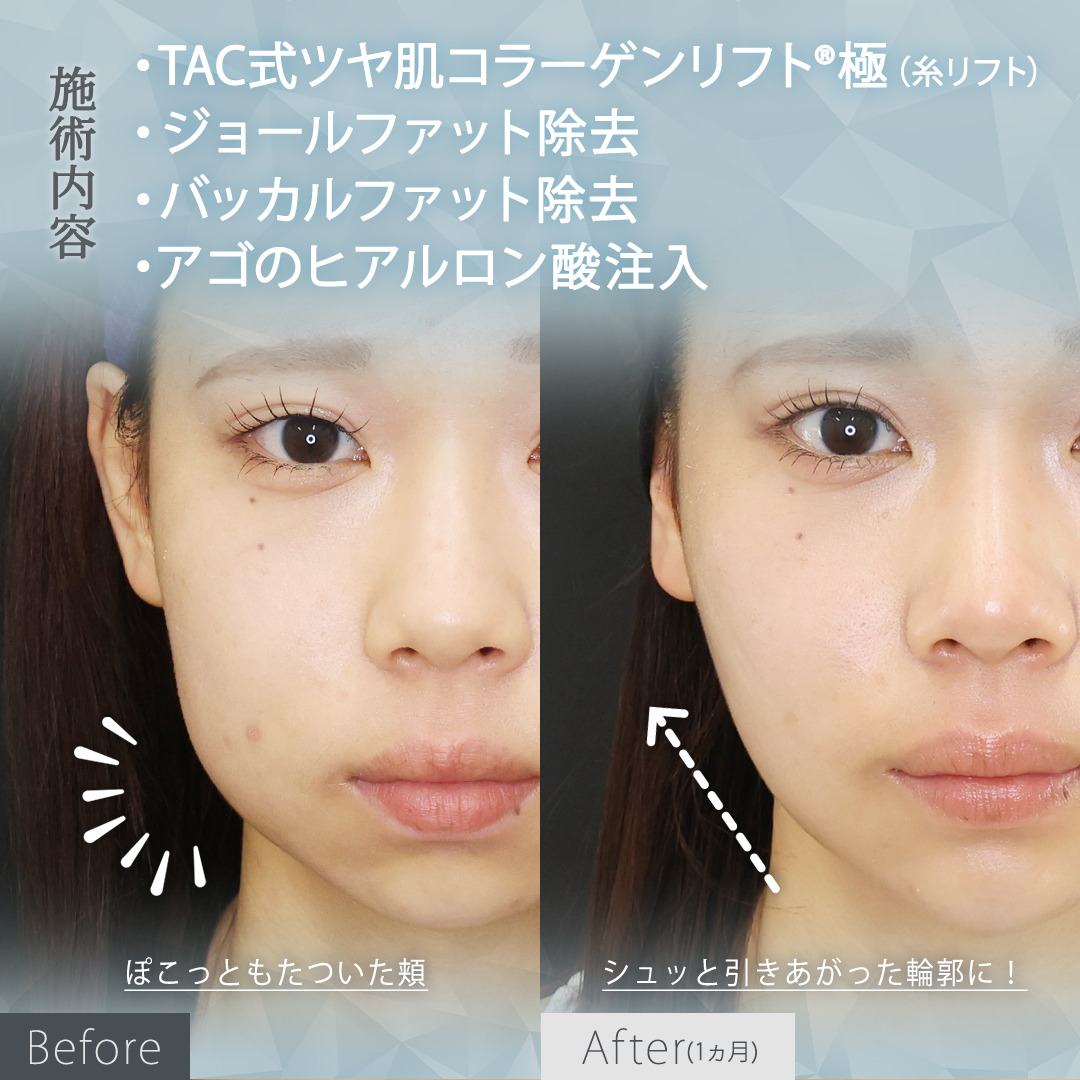 TAC式 ツヤ肌コラーゲンリフト®/顎のヒアルロン酸注射/ジョールファット除去の症例写真 施術前後 