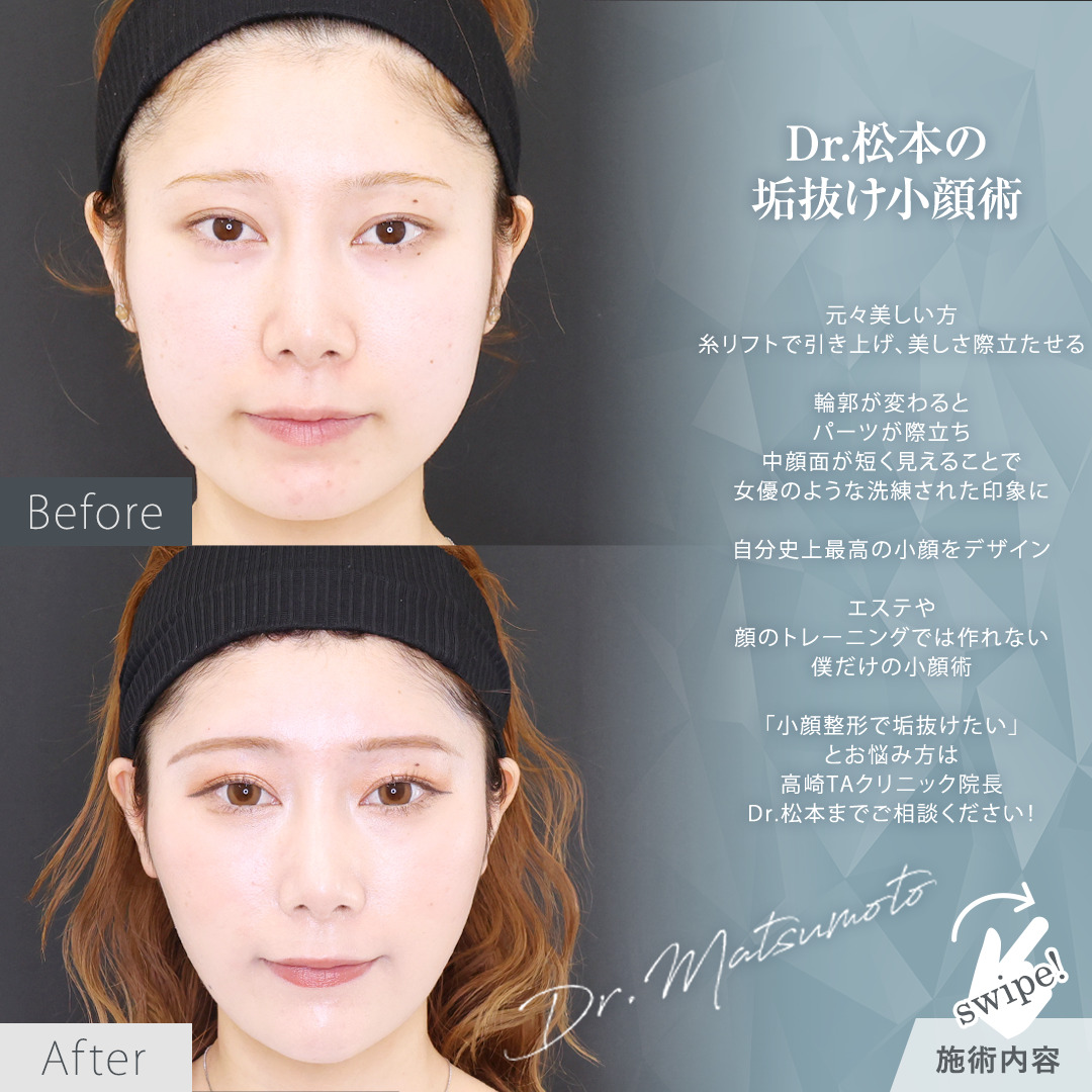 TAC式 ツヤ肌コラーゲンリフト®/バッカルファット除去/Lラインファット除去（エラ下脂肪除去）の症例写真 施術前後 