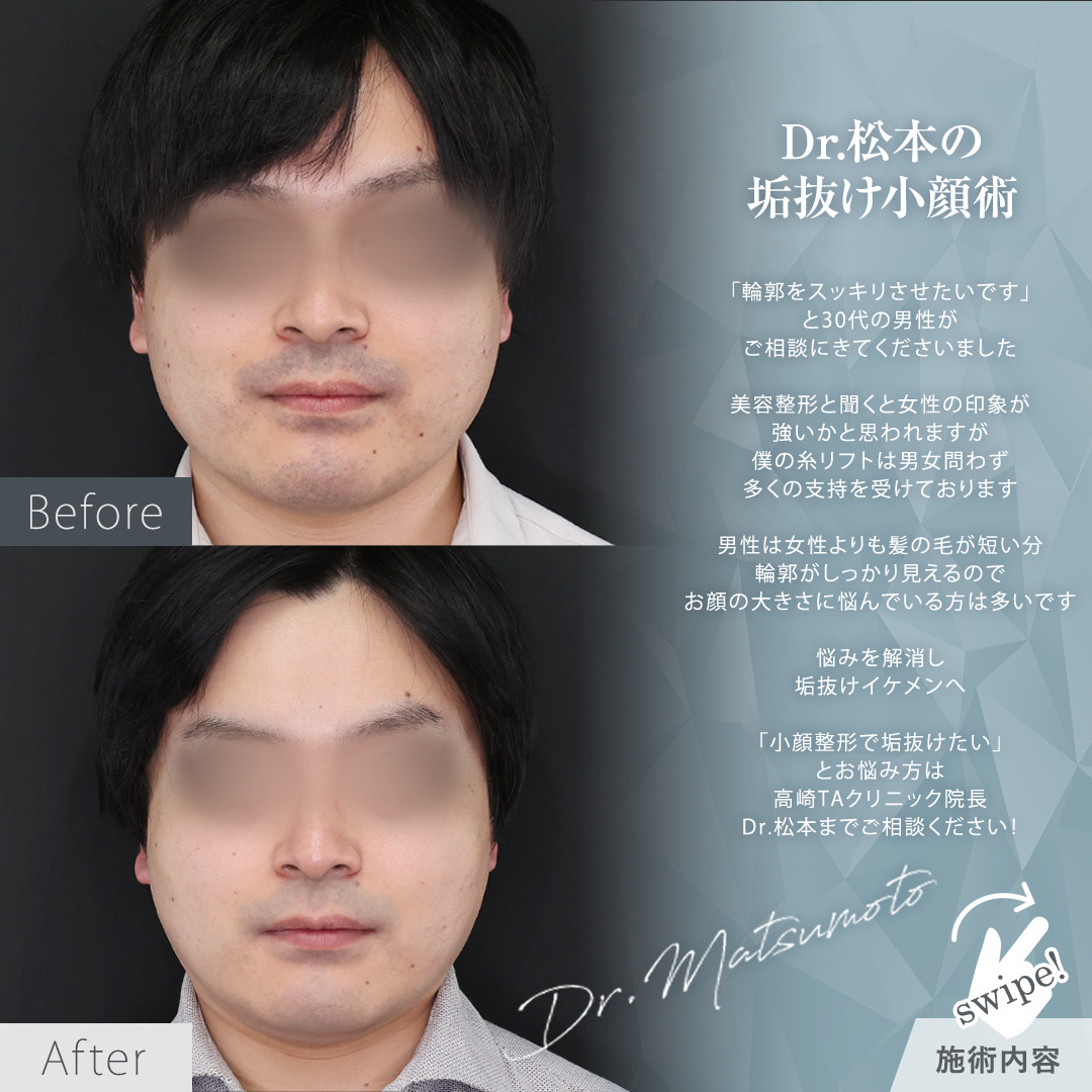 TAC式 ツヤ肌コラーゲンリフト®の症例写真 施術前後 