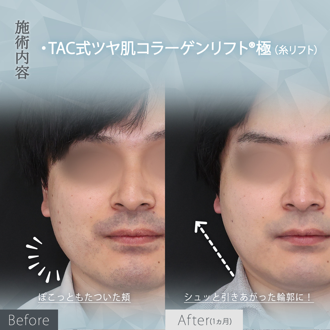 TAC式 ツヤ肌コラーゲンリフト®の症例写真 施術前後 