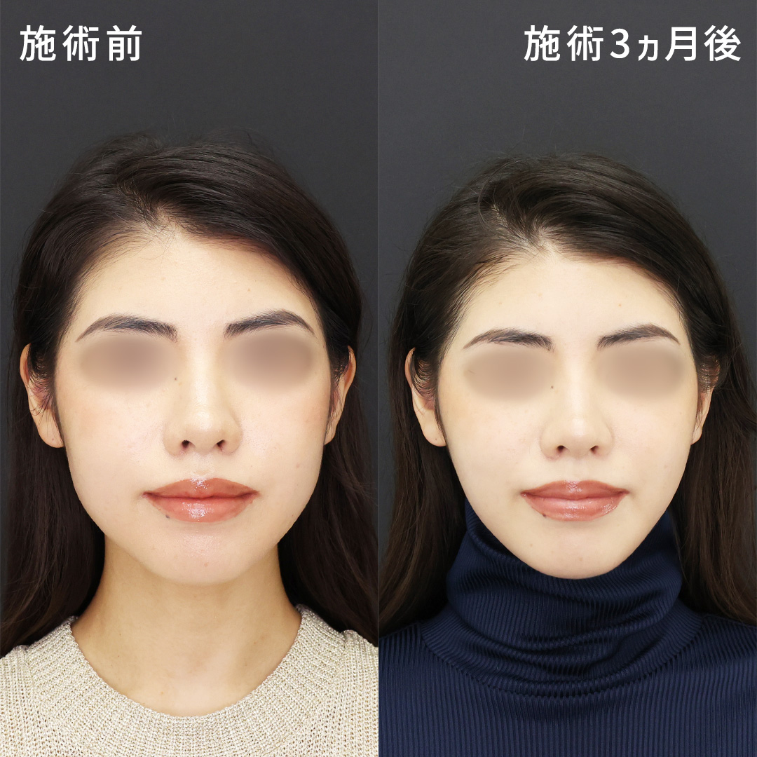 ベース型の輪郭を卵型に|もたつきナシの小顔術