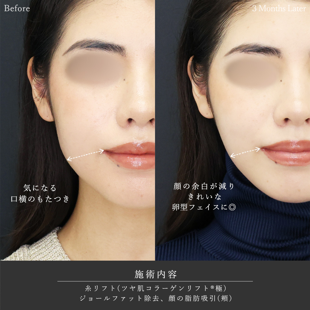 TAC式 ツヤ肌コラーゲンリフト®/ジョールファット除去/顔の脂肪吸引の症例写真 施術前後 