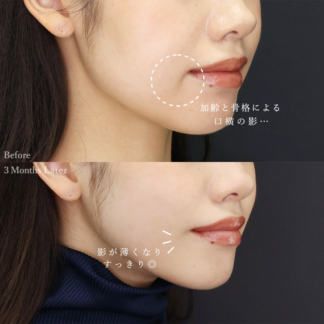 TAC式 ツヤ肌コラーゲンリフト®/ジョールファット除去/顔の脂肪吸引の症例写真 施術前後 